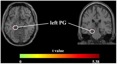 Altered Brain Structural Reorganization and Hierarchical Integrated Processing in Obesity